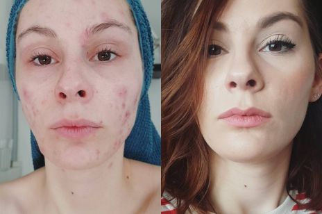 #Skinpositivity: kobiety pokazują twarz z trądzikiem