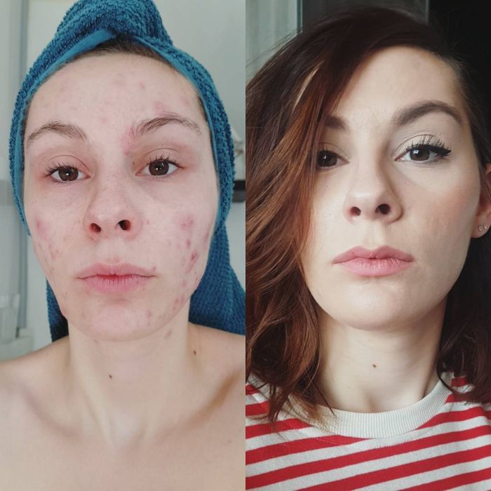 #Skinpositivity: kobiety pokazują twarz z trądzikiem