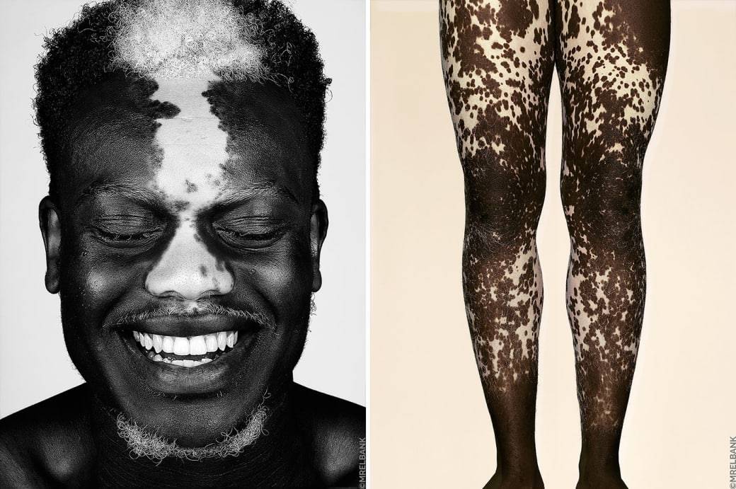 Brock Elbank "Vitiligo" projekt fotograficzny