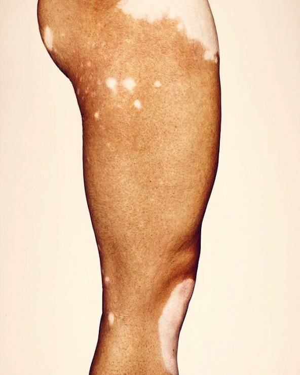 Brock Elbank "Vitiligo" projekt fotograficzny