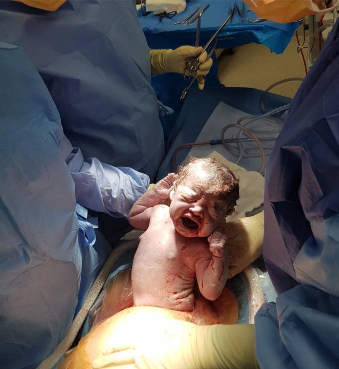 Poród przez cesarskie cięcie - zdjęcie