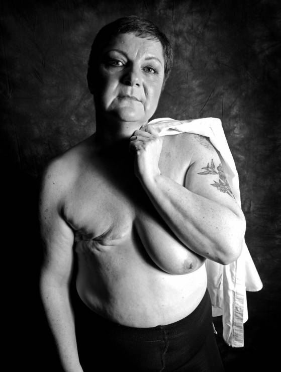 Kobieta po mastektomii